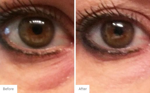 7 - Before and After Real Results photo of a woman's eye area.