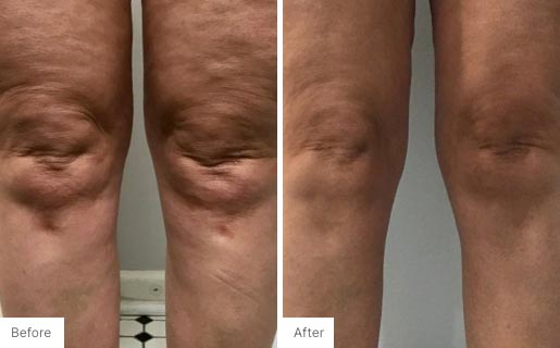 5 - Before and After Real Results photo of someone's legs.